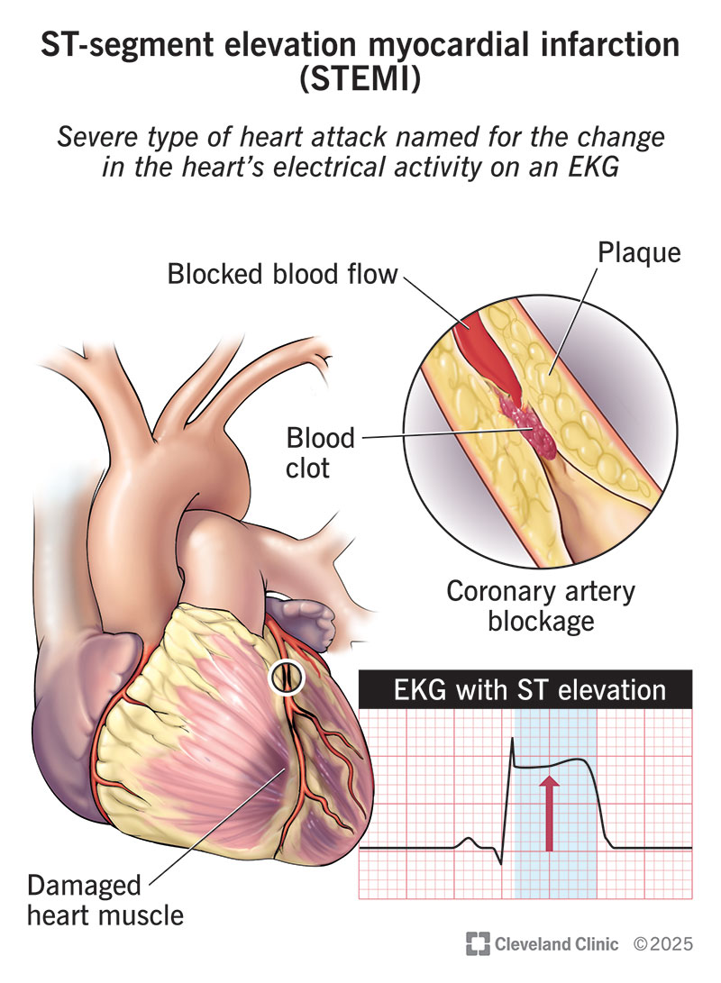 ST-Elevation Myocardial Infarction (STEMI):